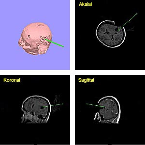 Figur 2    Intraoperativ navigering ved hjelp av MR-bilder. En tredimensjonal modell lages f&oslash;r operasjonen. Intraoperativt&hellip;