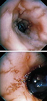  Figur 2    a) Endoskopisk bilde som viser den peptiske strikturen.  b) Endoskopisk bilde ved strikturblokking