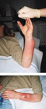  Figur 1a og b    Hud- og bl&oslash;tdelsinfeksjon etter &rdquo;bomskudd&rdquo; hos kvinnelig stoffmisbruker