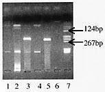 Figur 3    Etidiumbromidfarget gel ved PCR-unders&oslash;kelse for t(11;14). Br&oslash;nn 1, 2 og 4 negativ reaksjon for pasient 1, 2 og 5&hellip;