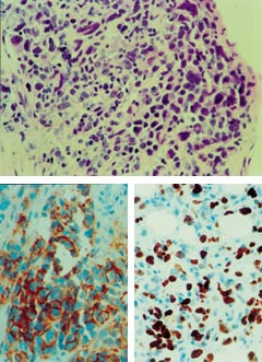 Figur 4    Biopsi fra h&oslash;ygradig malignt non-Hodgkinslymfom av T-celletype fra pasient 4. a) Hematoksylin/eosin/safran-farget&hellip;