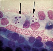 Figur 2    Adenokarsinomceller fremstilt ved Diff-Quick-farging. Ved pilmerkene sees intracytoplasmatiske vakuoler som f&oslash;rst&hellip;