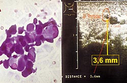 Figur 3    a) Diff-Quick-farget finn&aring;lsaspirat fra tumor p&aring; halsen. Mikroskopisk sees karsinomceller og kolloid forenlig med&hellip;