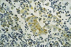 Figur 1  Celleblokk av ascitesv&aelig;ske med lymfocytter, mesotelceller og karsinomceller med tydelig membranfarging for Ber-EP4