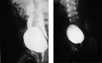  Figur 3    Miksjonscystografi  a) f&oslash;r og b) etter endoskopisk behandling