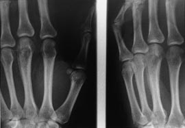  Figur 1    R&oslash;ntgenbillede af venstre h&aring;nd viser en patologisk knoglestruktur svarende til 3. metacarp med periosteal&hellip;