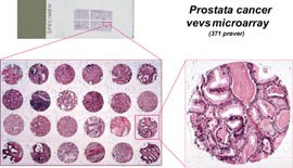 Figur 13    Vevsmikroarraymetoden anvendt p&aring; 371 tilfeller av prostatakreft (89). Hvert tilfelle er representert ved sm&aring;&hellip;
