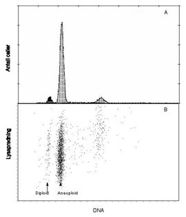Figur 3    DNA-fordelingshistogram fra nevroblastom hos barn. A viser en dominerende aneuploid cellepopulasjon som er&hellip;