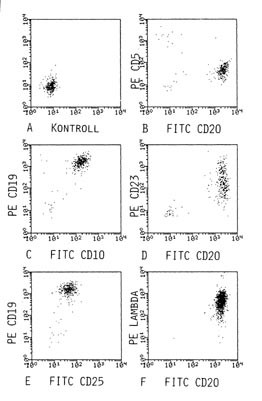 Figur 5    Tofarge fluorescenscytogrammer (FITC; fluorescin isotiocyanat, PE; fykoerytrin) fra samme pasient som i figur 2,&hellip;