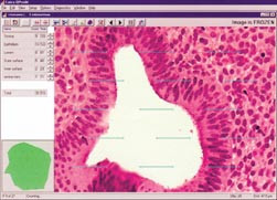 Figur 3    Utsnitt av endometriekjertel ved hyperplasi til venstre i bildet, stroma til h&oslash;yre. Man registrerer hvor&hellip;