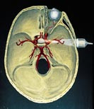 Kraniemodellen viser probens temporale plassering ved transkranial ultralyddopplerunders&oslash;kelse av hjernearteriene. Gjengitt&hellip;