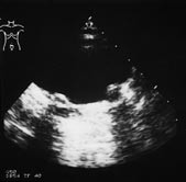  Figur 4    Ultralydunders&oslash;kelse som viser teflonpasta under ureterostiene