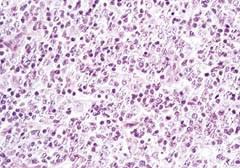 Figur 4    Lysmikroskopisk unders&oslash;kelse av lymfeknute fra pasient 2 (HE, 40 &sdot; ). Store deler av lymfeknutestrukturen var&hellip;