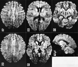 Figur 2  Aksiale (A &ndash; E) og sagittale (F) diffusjonsvektede MR-bilder (ekkoplanar; b = 1 000 sek/mm2; TR/TE = 4700/118; x, y&hellip;