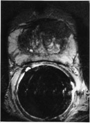 Figur 3  Aksialt endorektalt MR-bilde (T2-vektet) viser hypointens tumor fortil p&aring; venstre side (pil) hos pasient med&hellip;