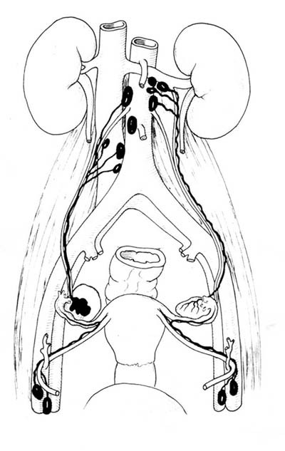 Figur 3a  Eggstokkenes lymfatiske drenasjesystem