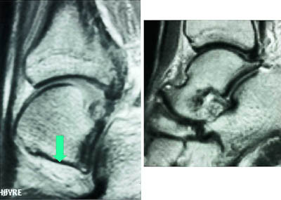 Figur 2  a) Sagittalt protonvektet bilde viser normalt fett i sinus tarsi, mens b) sagittalt T2-vektet sekvens viser nedsatt&hellip;