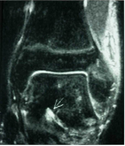 Figur 3  Koronalt T2-vektet &laquo;short tau inversion recovery&raquo;-sekvens (STIR) viser v&aelig;skeansamling i sinus tarsi, forenlig med&hellip;