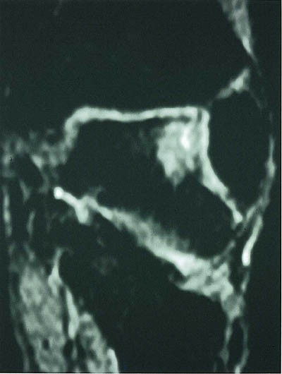 Figur 5  Koronal STIR-sekvens viser osteokondral skade ved &oslash;vre laterale hj&oslash;rne av os talus hos en pasient med mistenkt&hellip;