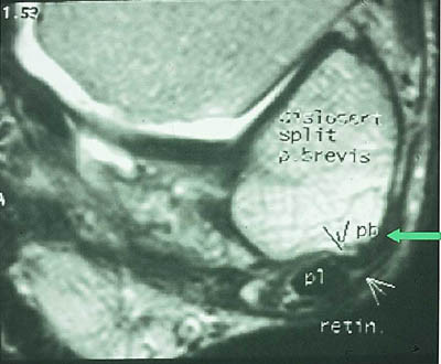 Figur 6  Aksial T2-vektet sekvens viser posttraumatisk subluksasjon og avflatning av peroneus brevis-senen, mens peroneus&hellip;