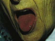 Figur 1  Glatt atrofisk tunge