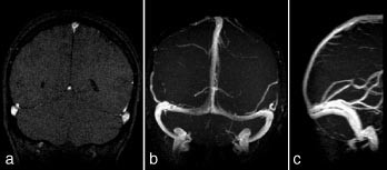 Figur 2  2D-innstr&oslash;mnings-MRA av de store venesinuser i bakre halvdel av hodet. a) Koronalt enkeltsnitt, b) maksimal&hellip;