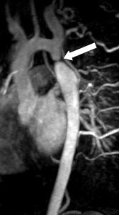 Figur 6  Kontrastforsterket MRA av coarctatio aortae. Selve koarktasjonen sees som en markert innsnevring (pil) p&aring; aorta&hellip;