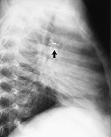 Figur 1 R&oslash;ntgenbilde i sideprojeksjon av en gutt p&aring; ett &aring;r og to m&aring;neder som har f&aring;tt implantert en 12 mm paraply i en 2 mm&hellip;