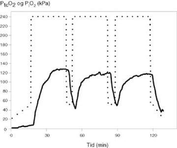 Figur 2 Transkutane oksygentensjonsverdier hos pasient under tre oksygenperioder &atilde; 30 minutter p&aring; 240 kPa. Stiplet linje&hellip;