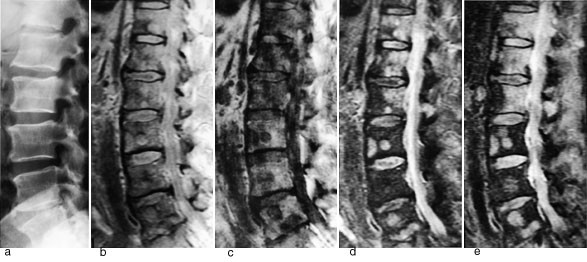 Figur 1  Sidebilder av lumbalcolumna hos 68 &aring;r gammel mann med cancer prostatae. a) Konvensjonelt r&oslash;ntgenbilde. Ingen&hellip;