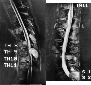 Figur 2 a og b  STIR-bilder i sideplan av 51 &aring;r gammel mann med cancer prostatae. MR viser b&aring;de metastaser og&hellip;