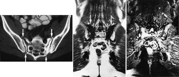 Figur 4  Bekkenunders&oslash;kelse hos 60 &aring;r gammel kvinne som gjennomgikk str&aring;lebehandling for cancer cervicis uteri sju &aring;r&hellip;