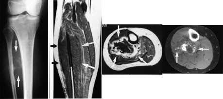 Figur 5  Osteogent sarkom i h&oslash;yre fibula hos 50 &aring;r gammel kvinne. a) Konvensjonelt r&oslash;ntgenbilde viser sklerose i midtre del&hellip;