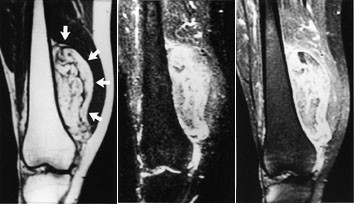 Figur 7  Frontalbilder av liposarkom i h&oslash;yre l&aring;r hos 38 &aring;r gammel mann. a) T1-vektet bilde. Tumor har h&oslash;yt signal, som fett,&hellip;