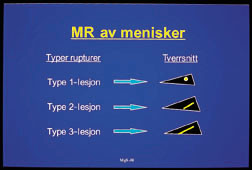 Figur 2  Ulike typer av meniskdegenerasjoner