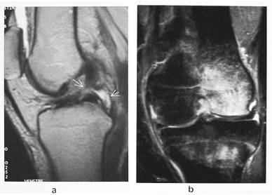 Figur 7  a) Sagittal T2-vektet sekvens hos en kvinnelig h&aring;ndballspiller viser ruptur av b&aring;de fremre og bakre korsb&aring;nd &hellip;