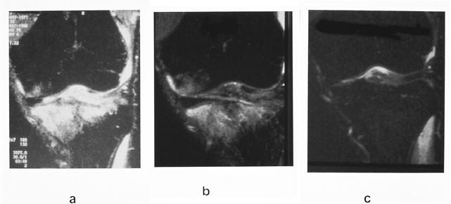 Figur 9  Akutt kneskade hos en toppidrettsut&oslash;ver. Klinisk mistanke om ruptur av fremre korsb&aring;nd og mediale menisk. Man&hellip;