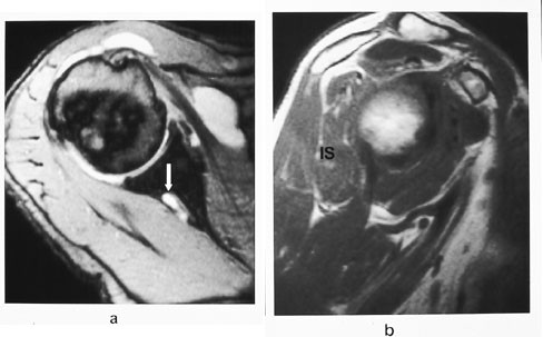 Figur 11  a) Pasient med innklemmingssyndrom for&aring;rsaket av et ganglion (pil) i n. suprascapularis, med b) atrofiforandringer&hellip;