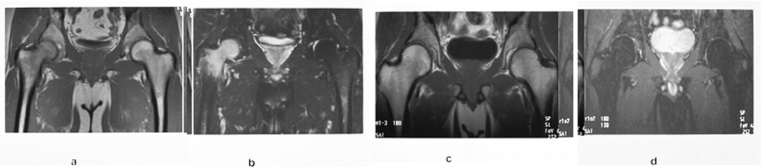 Figur 14  49-&aring;rig mann med uttalte h&oslash;yresidige hoftesmerter. Konvensjonell r&oslash;ntgen var negativ.  a) Koronal T1-vektet&hellip;