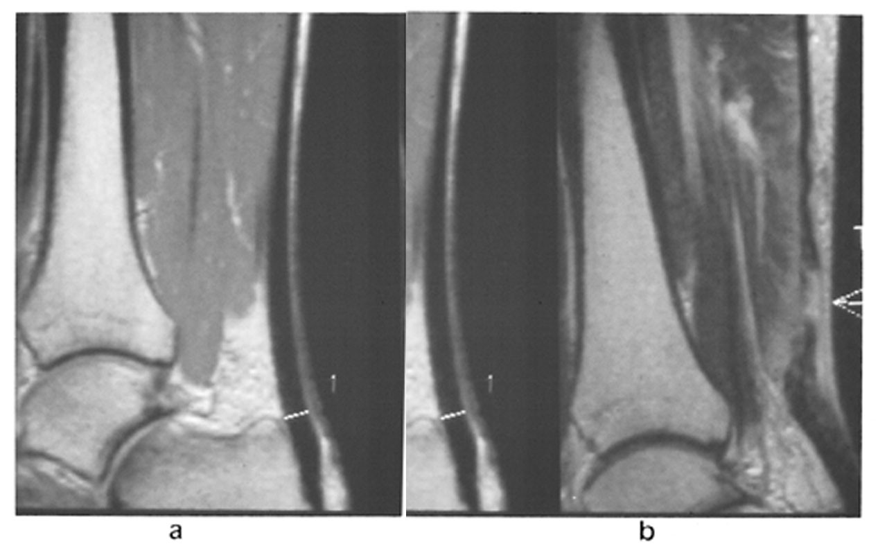 Figur 17  a) Sagittal PD-vektet sekvens viser en normal akillessene, mens b) e&hellip;n pasient, som f&oslash;lge av kampsport, har en&hellip;