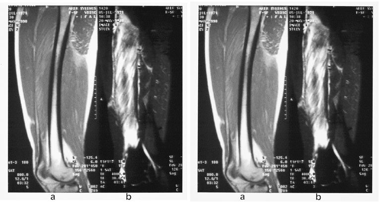 Figur 18  Akutt muskelkontusjon i m. rectus femoris og m. vastus medialis etter kraftig l&aring;rh&oslash;ne.  a) Sagittal PD og b) T2&hellip;