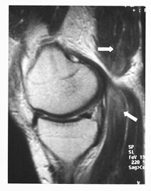 Figur 19  Pasient med muskelsmerter bak i knehasen fire dager etter sykkelritt p&aring; ca. 30 mil. Sagittal T2-vektet sekvens&hellip;