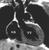 Figur 1    T1-vektet frontalsnitt gjennom hjertet. HA = h&oslash;yre atrium, VV = venstre ventrikkel. Gjengitt med tillatelse (3)