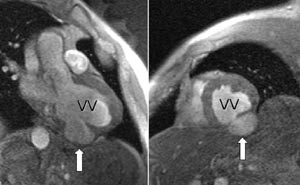 Figur 6    Aneurisme (pil) utg&aring;ende fra bakre vegg av venstre ventrikkel (VV) hos 51 &aring;r gammel mann. Endesystolisk a)&hellip;