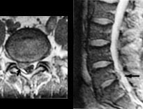 Figur 6    48 &aring;r gammel mann med vedvarende h&oslash;yresidig isjias.  a) T1-vektet aksialt bilde gjennom 5. lumbalskive viser&hellip;