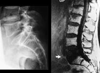 Figur 7    63 &aring;r gammel mann med kjent prim&aelig;r leversvulst og nylig oppst&aring;tte ryggsmerter. a) Konvensjonelt r&oslash;ntgenbilde av&hellip;