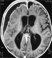 Figur 8    &Aring;tte m&aring;neder gammelt barn med fire ukers sykehistorie med meningitt. Oppladning i fortykkede hjernehinner og&hellip;