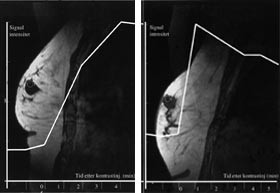 Figur 1    Dynamisk T1-vektede kontrast-MR-unders&oslash;kelser av bryst med sagittal snittretning. Disse to pasientene var&hellip;