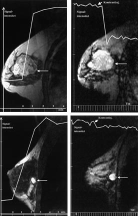 Figur 2    a) Dynamisk T1-vektet kontrastunders&oslash;kelse av pasient som deltok i en studie av kjemoterapieffekt vurdert med MR&hellip;