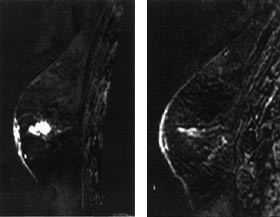 Figur 4    Dynamisk T1-vektet kontrastunders&oslash;kelse av brystkreftsvulst (subtraksjonsbilder). Pasienten var deltaker i en&hellip;